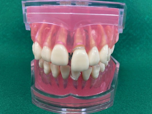 簡単に口閉じができるエンゼル・ケアの㊙必需品 !! ニュース画像1