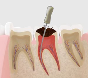 成功率を高めるための根管治療法とは？ ニュース画像1