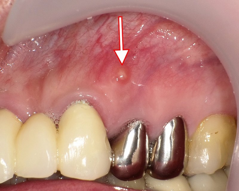 フィステル？歯茎に出来たニキビの様な腫れの原因と治療法 ニュース画像1