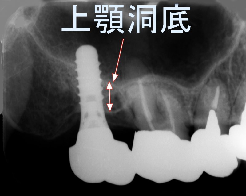 骨が足りなくても大丈夫！上顎インプラントの新常識 ニュース画像1