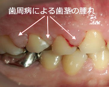 歯茎が突然腫れたら？考えられる原因と応急処置 ニュース画像1