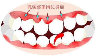 妊娠性歯肉炎：原因、症状、予防法と早産リスク ニュース画像1