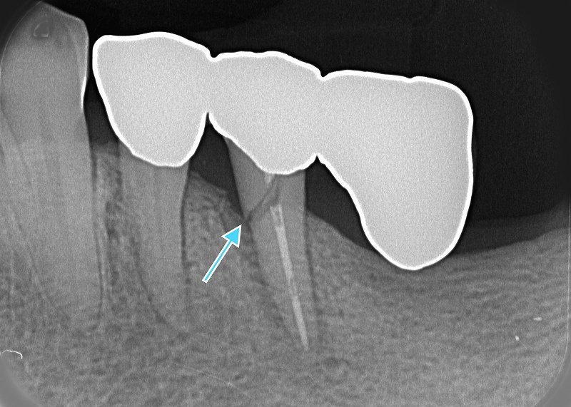 延長ブリッジのデメリット：実際の症例から学ぶリスク ニュース画像1