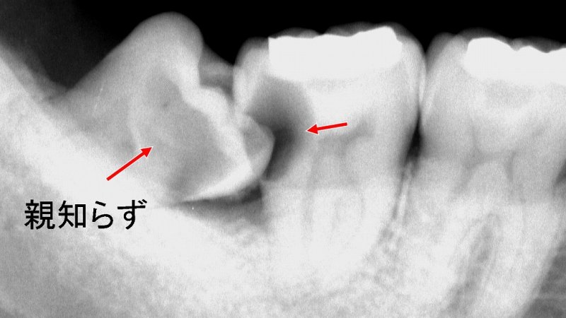 親知らずが原因で発生する7番の虫歯：原因と治療法 ニュース画像1