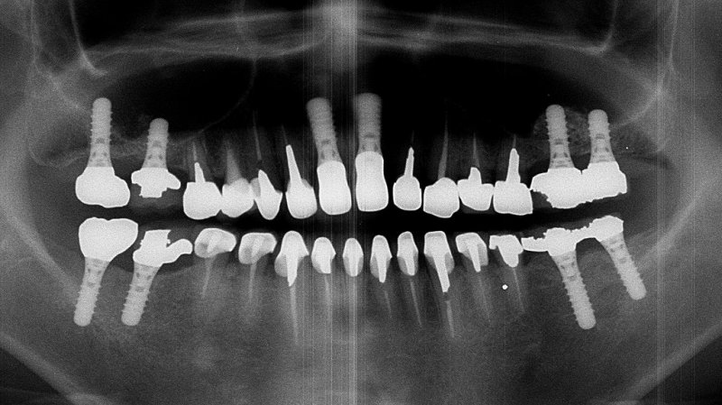 当院なら可能なインプラント多数歯欠損症例 ニュース画像1