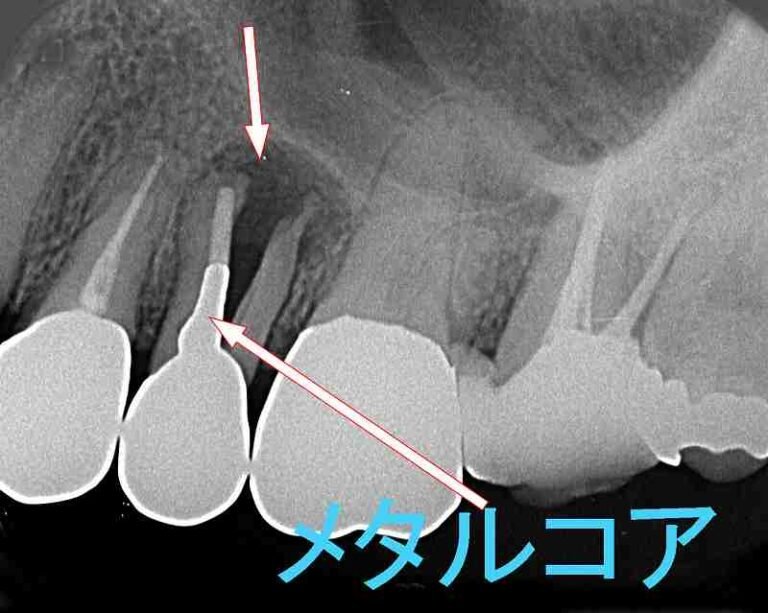 歯根破折でも抜歯しない選択肢：保存治療のすべて ニュース画像1