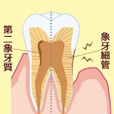 知覚過敏とは？その原因と症状、効果的な治療法を徹底解説 ニュース画像1