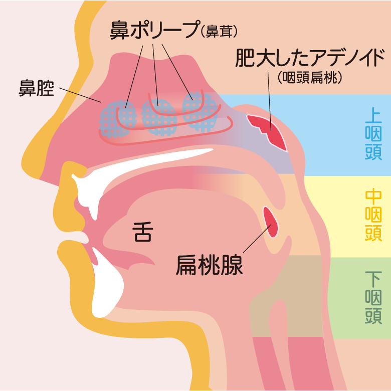 アデノイドとは？その役割と肥大による影響 ニュース画像1