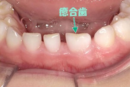 子どもの前歯が大きい…もしかして癒合歯？見分け方と対応 ニュース画像1