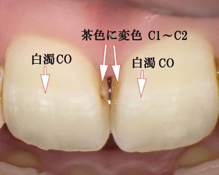 歯が白く濁って見える…それ、初期虫歯かもしれません ニュース画像1