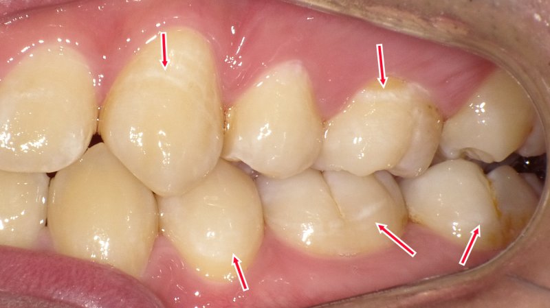 虫歯を自力で治すには？初期虫歯の再石灰化とセルフケア ニュース画像1