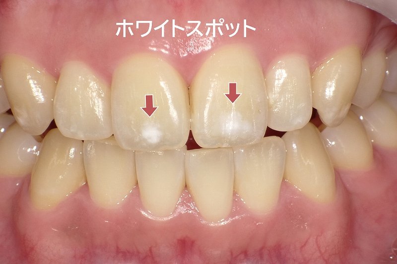 子どもの歯に白いシミ…ホワイトスポットの原因と治療 ニュース画像1