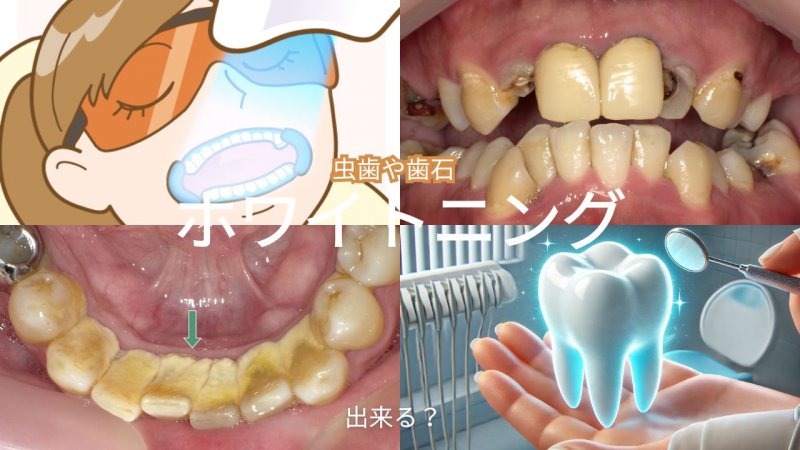虫歯があるとホワイトニングできないって本当？ ニュース画像1