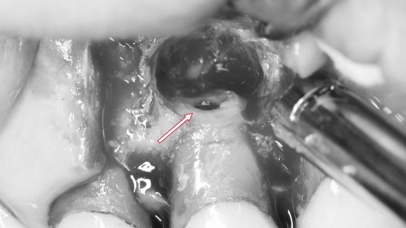 再発する根の病気に「最後の一手」｜歯根端切除術とは ニュース画像1
