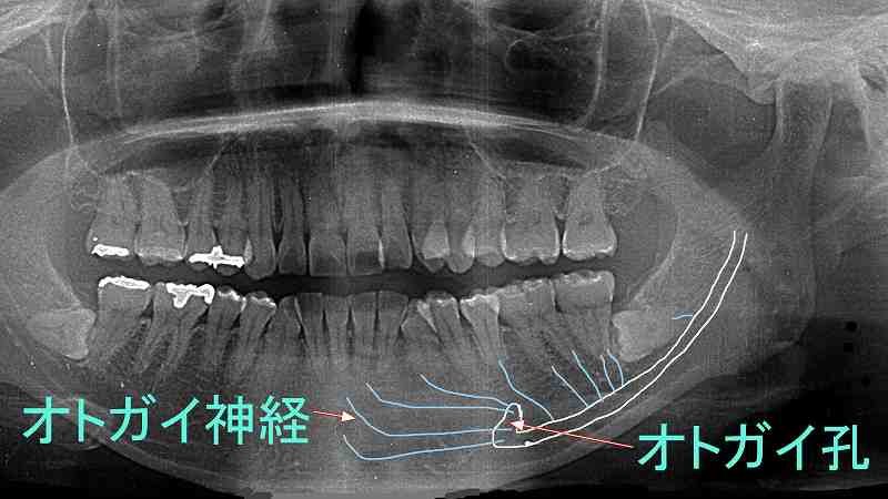 オトガイ神経麻痺とは？歯科治療後の唇のしびれや違和感 ニュース画像1