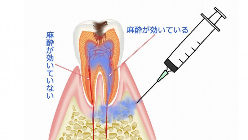 浸潤麻酔とは？歯科治療の痛みをやわらげる基本の麻酔法 ニュース画像1