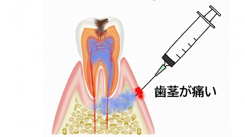 唇を噛んでしまった…歯科麻酔後のトラブルとケア方法 ニュース画像1