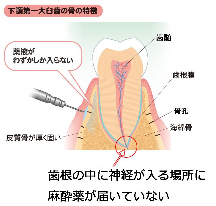 なぜ麻酔が効かないの？下顎奥歯の治療が痛い理由と対策 ニュース画像1
