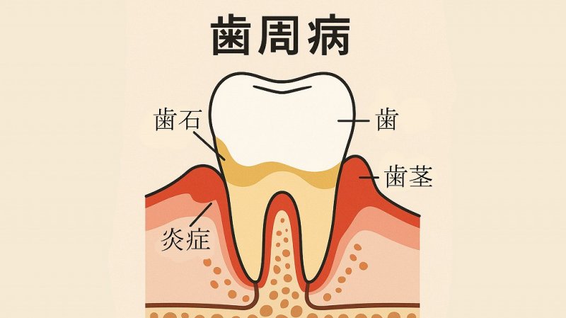 血圧が高い人は歯にも注意！歯周病と高血圧の深い関係 ニュース画像1