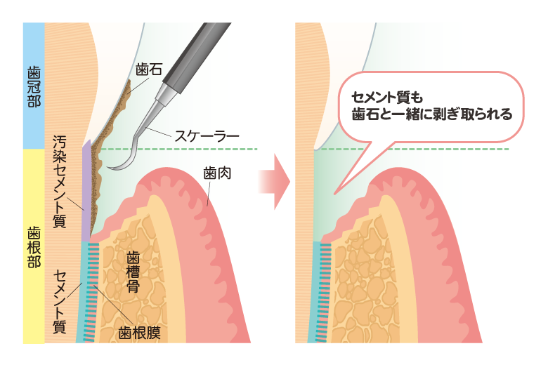 SRPとは？歯周病を根本改善する基本治療と効果・費用 ニュース画像1