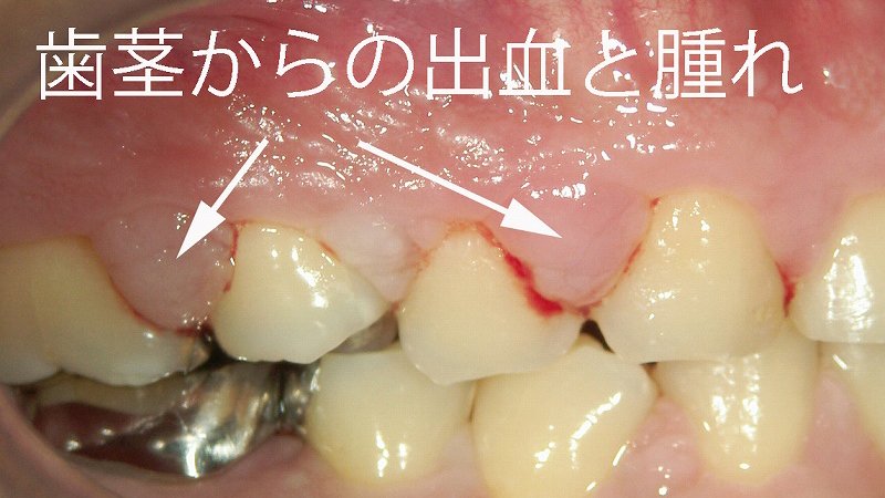 歯肉増殖症の原因・症状・治療法を徹底解説 ニュース画像1