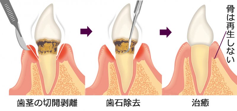 歯周病を進行させないために｜外科的アプローチと再生療法 ニュース画像1