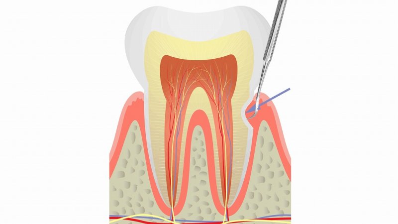 歯石取りの必要性と効果｜頻度・費用・リスクまで徹底解説 ニュース画像1