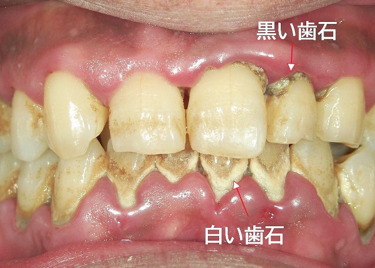歯石取りを自分でやる前に読むべき注意点とおすすめ予防法 ニュース画像1