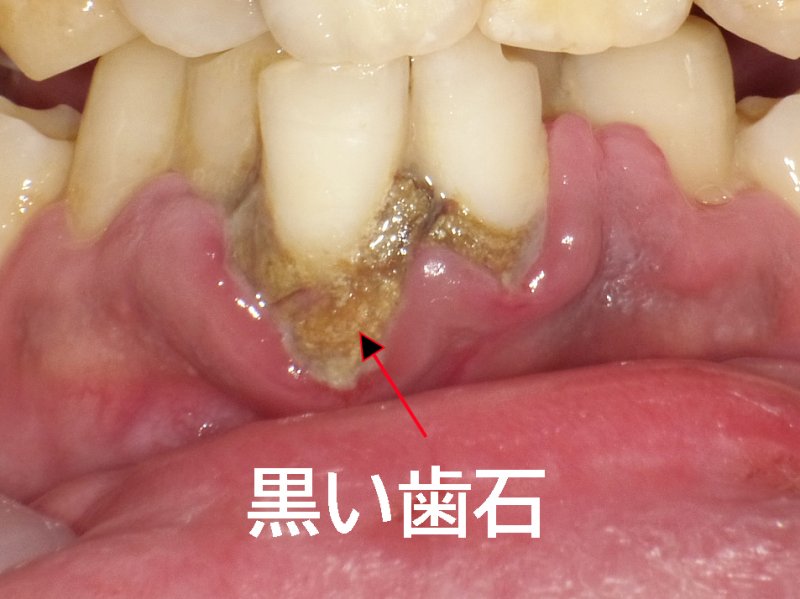 黒い歯石は危険？白い歯石との違いと放置リスク・取り方 ニュース画像1
