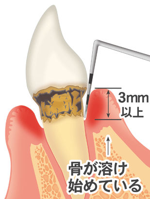 歯周ポケットとは？正常な深さ・原因・治療法を徹底解説 ニュース画像1