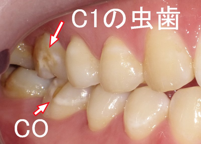 虫歯C1とは？｜COとの違い・見た目・治療法を解説 ニュース画像1