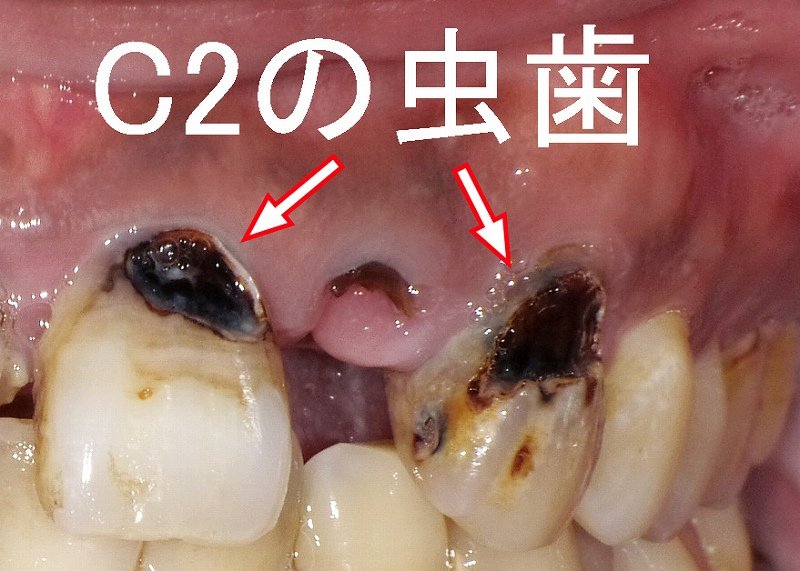 虫歯C2段階は痛みなしで進行？早期発見のポイントと治療 ニュース画像1