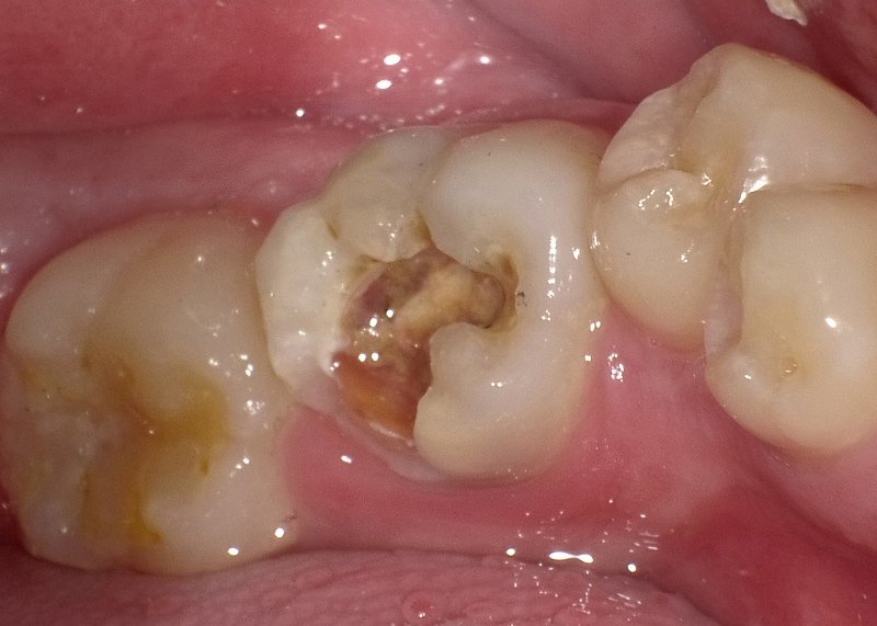 虫歯C3を放置するとどうなる？症状の進行段階と根管治療 ニュース画像1