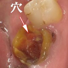 虫歯C4で抜歯が必要？保存できるケースと最新の治療法 ニュース画像1