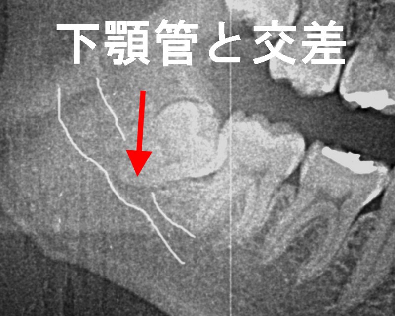 神経に近い親知らずは危険？抜くべきか迷った時の判断基準 ニュース画像1
