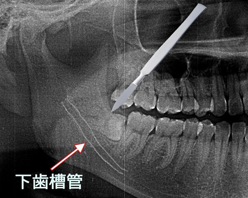 親知らずの抜き方とは？抜くべきケースと安全な手順を解説 ニュース画像1