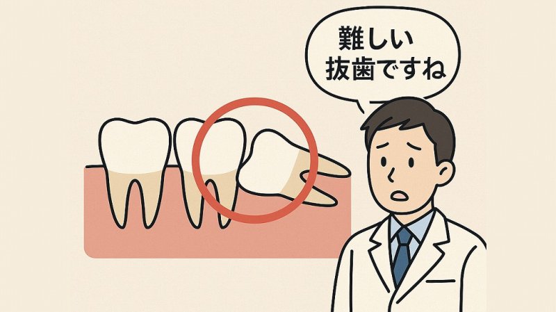 親知らずの抜歯難易度とは?下顎・上顎別の違いとリスク ニュース画像1