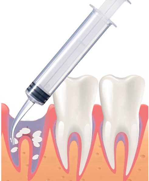 親知らず抜歯後の穴はいつ塞がる?期間の目安とケア方法 ニュース画像1