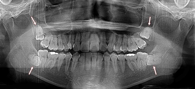 横向きの親知らずガイド|レントゲン診断から治療・費用 ニュース画像1