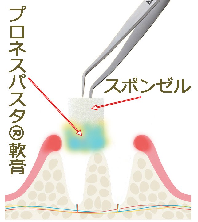 ドライソケット治療とセルフケア｜親知らず抜歯後の注意点 ニュース画像1