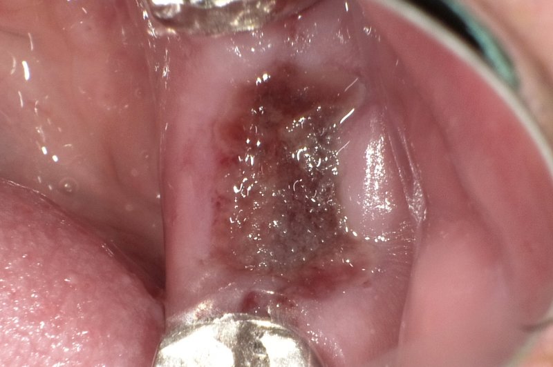 血餅とは?抜歯後の治癒を支える“天然のかさぶた”のケア ニュース画像1