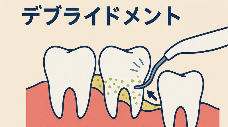 デブライドメントとは?スケーリングとの違い・効果を解説 ニュース画像1