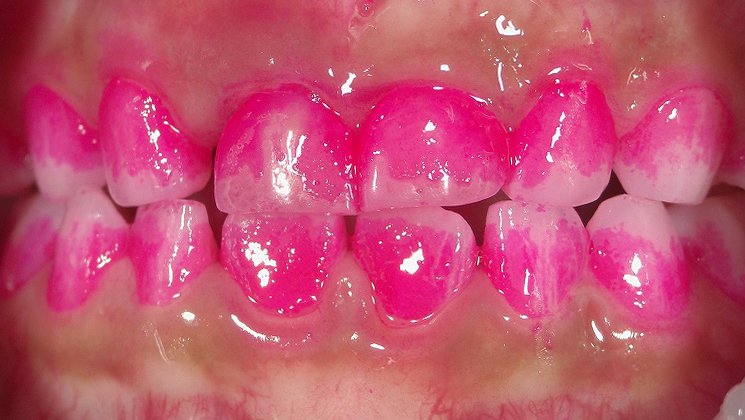 歯の染め出しとは？自宅でできる磨き残しチェックと使い方 ニュース画像1