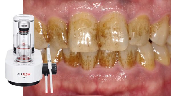 エアフローとは？痛みの少ない最新の歯のクリーニング法 ニュース画像1
