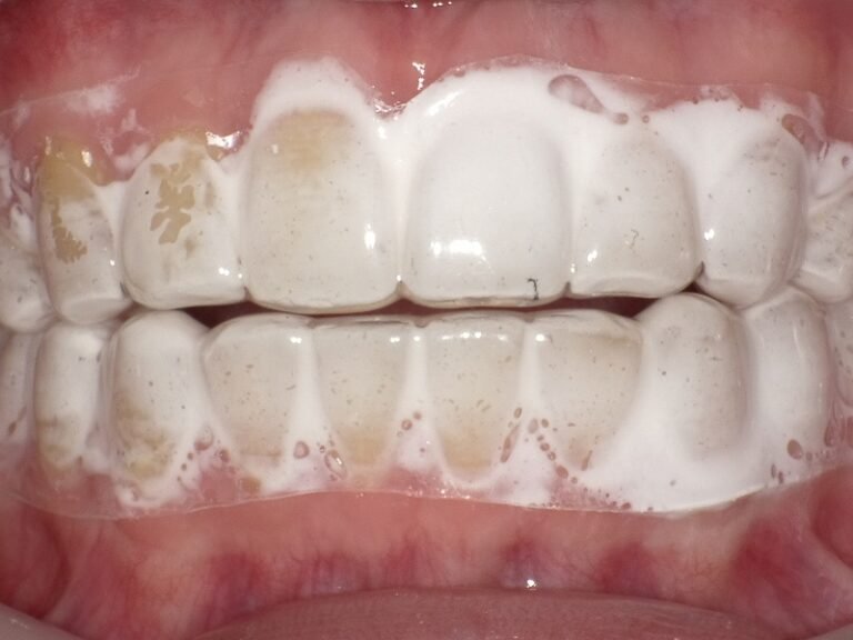 MIペーストとは?歯を削らずに守る「再石灰化ケア ニュース画像1