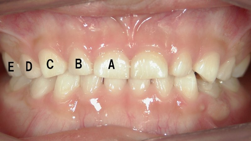 乳歯の名称と略号を正しく理解する ニュース画像1