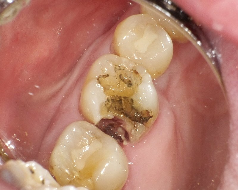 子どもの虫歯はなぜ起こるの?乳歯の特徴と予防のポイント ニュース画像1