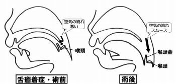 舌癒着症と口呼吸の関係 ― 鼻呼吸を取り戻すための理解 ニュース画像1