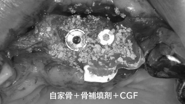 インプラント前に必要な骨づくり治療-ボーングラフト ニュース画像1