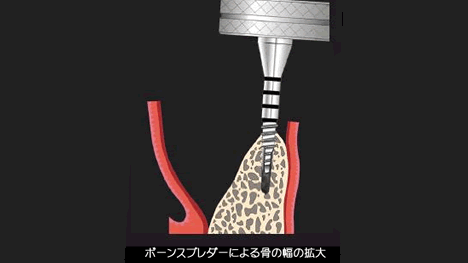 下顎の骨が薄くても可能?リッジエキスパンジョンの適応症 ニュース画像1